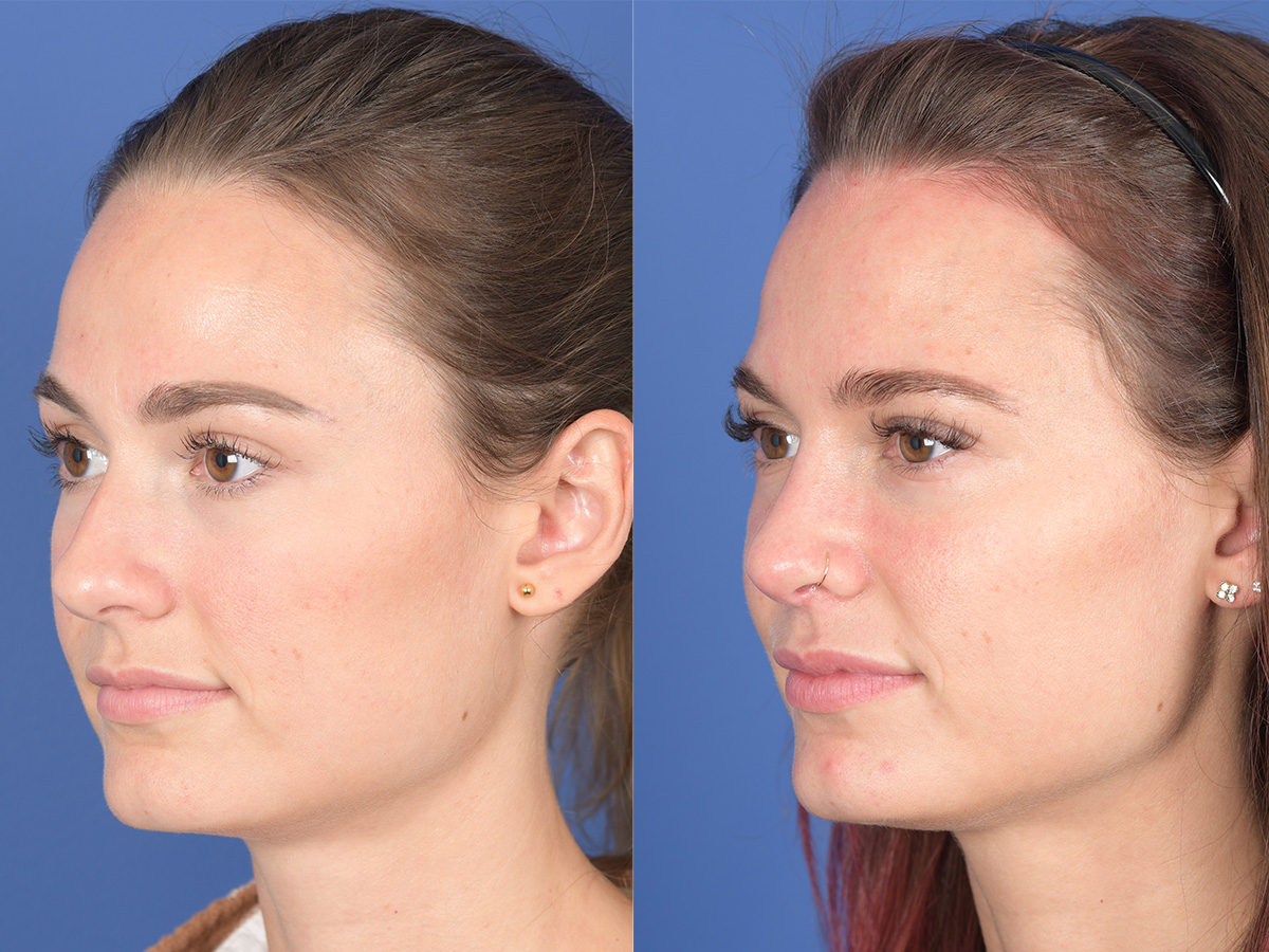 Rhinoplasty Before and After | Weber Facial Plastic Surgery