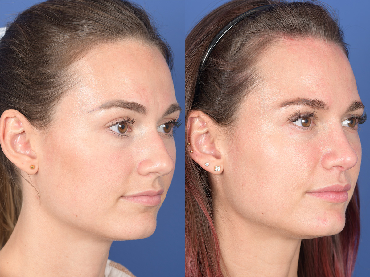 Rhinoplasty Before and After | Weber Facial Plastic Surgery