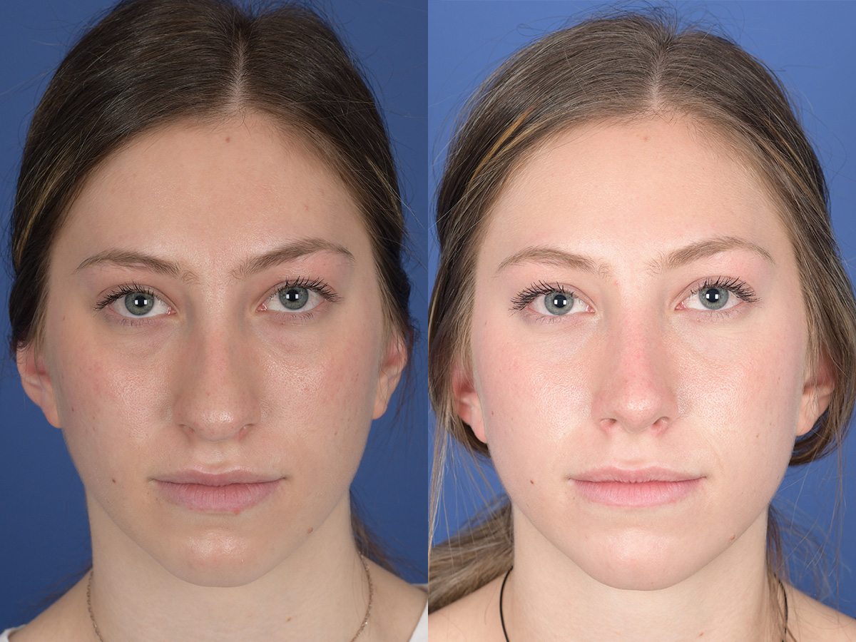 Rhinoplasty Before and After | Weber Facial Plastic Surgery