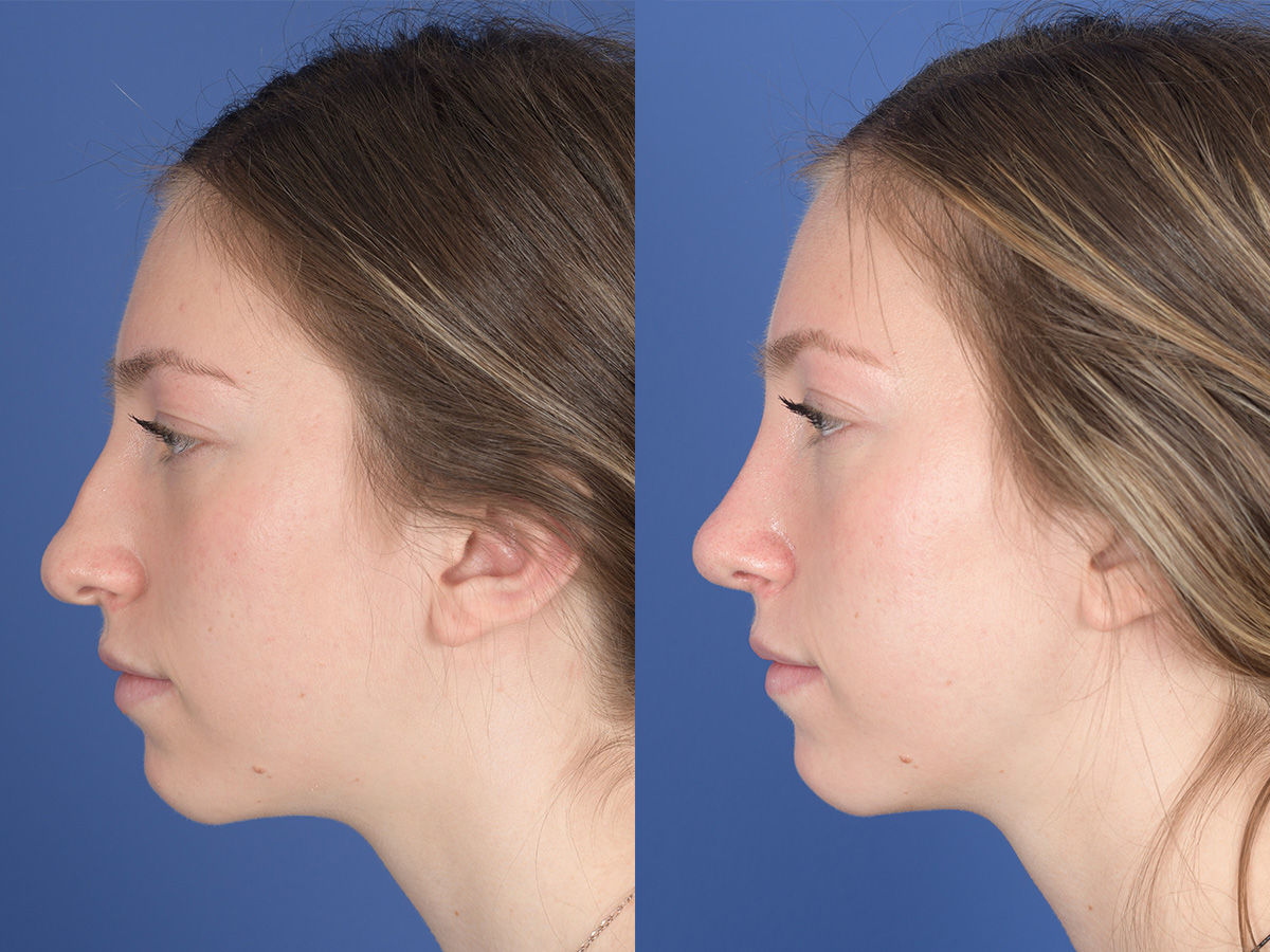 Rhinoplasty Before and After | Weber Facial Plastic Surgery