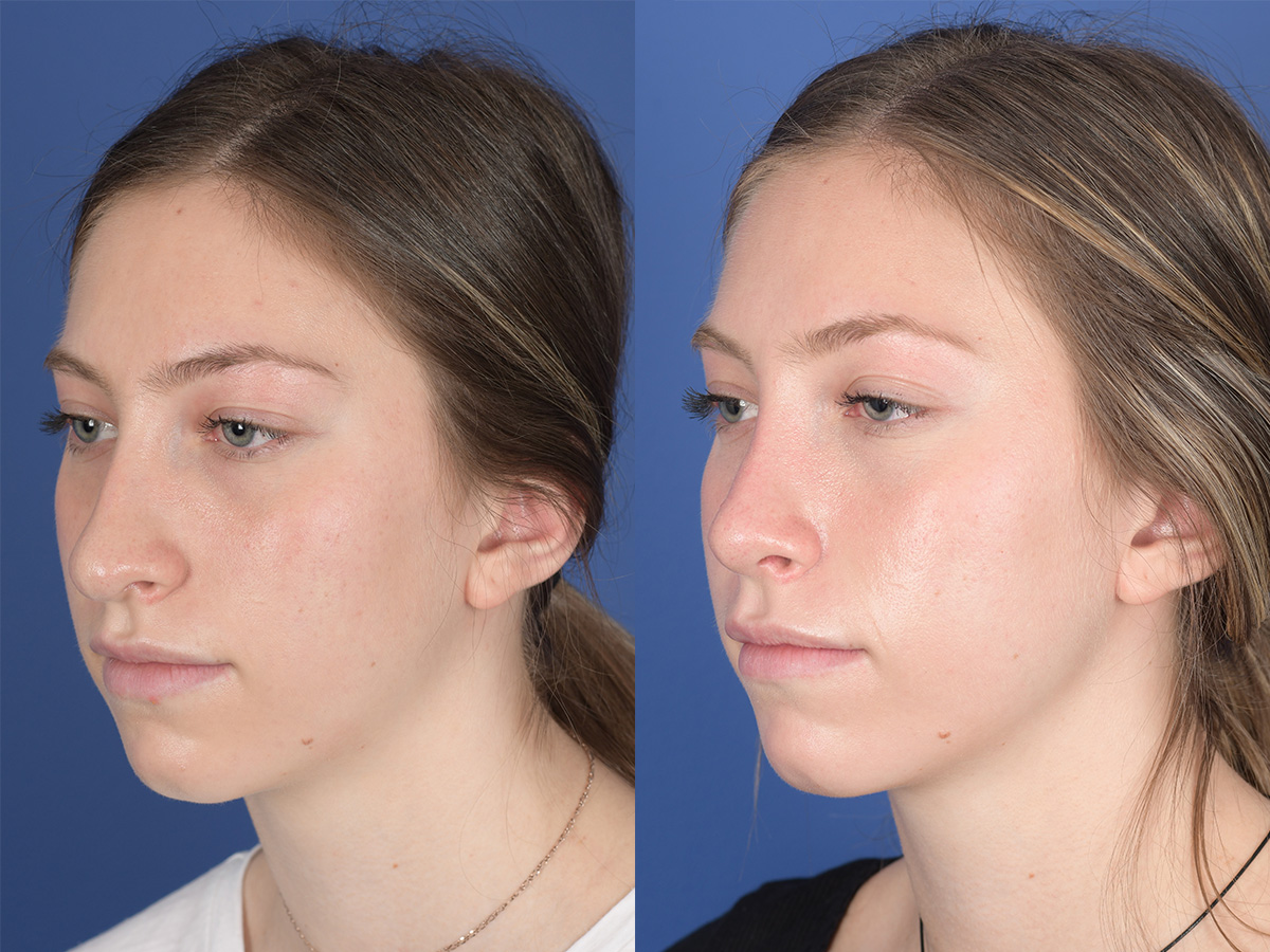 Rhinoplasty Before and After | Weber Facial Plastic Surgery