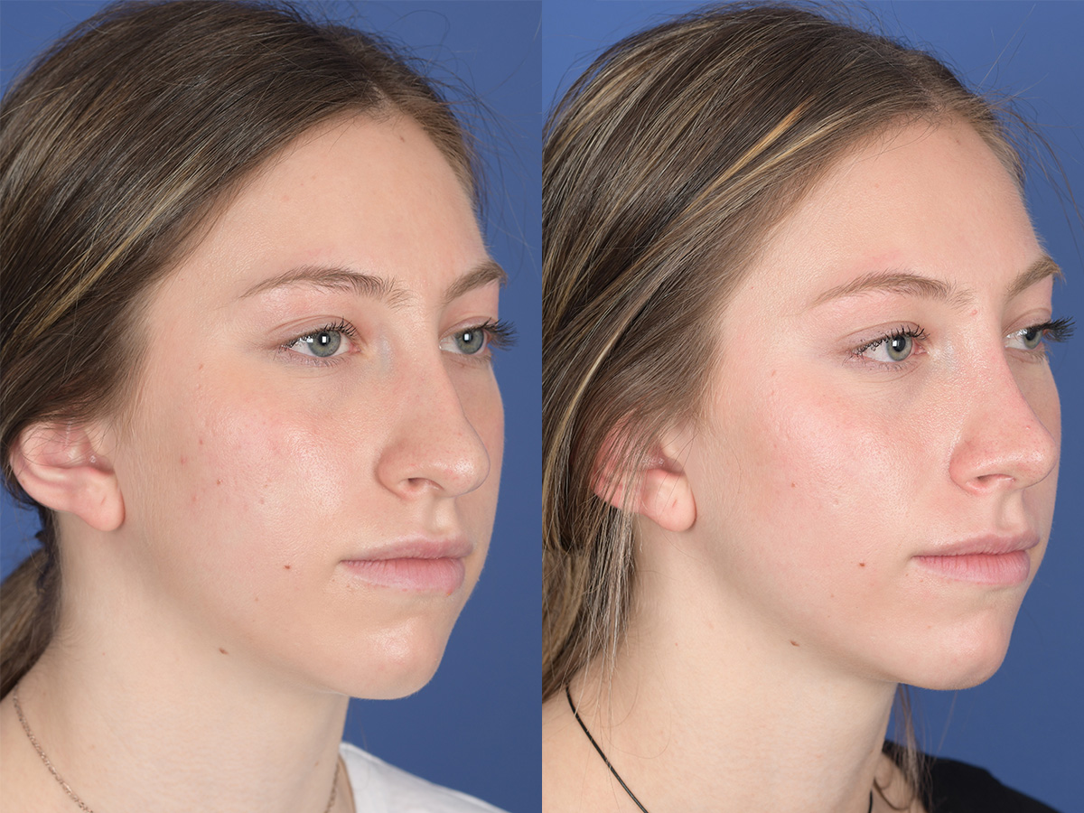 Rhinoplasty Before and After | Weber Facial Plastic Surgery