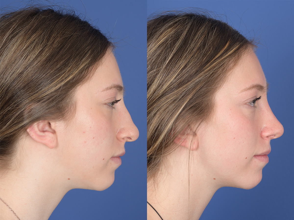 Rhinoplasty Before and After | Weber Facial Plastic Surgery