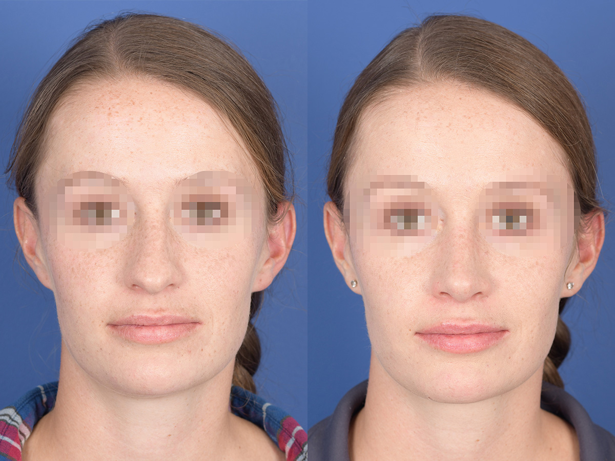 Rhinoplasty Before and After | Weber Facial Plastic Surgery