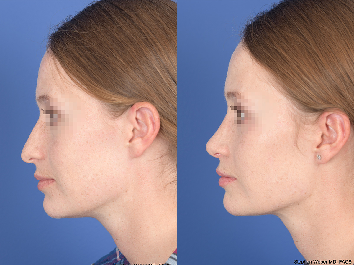 Rhinoplasty Before and After | Weber Facial Plastic Surgery