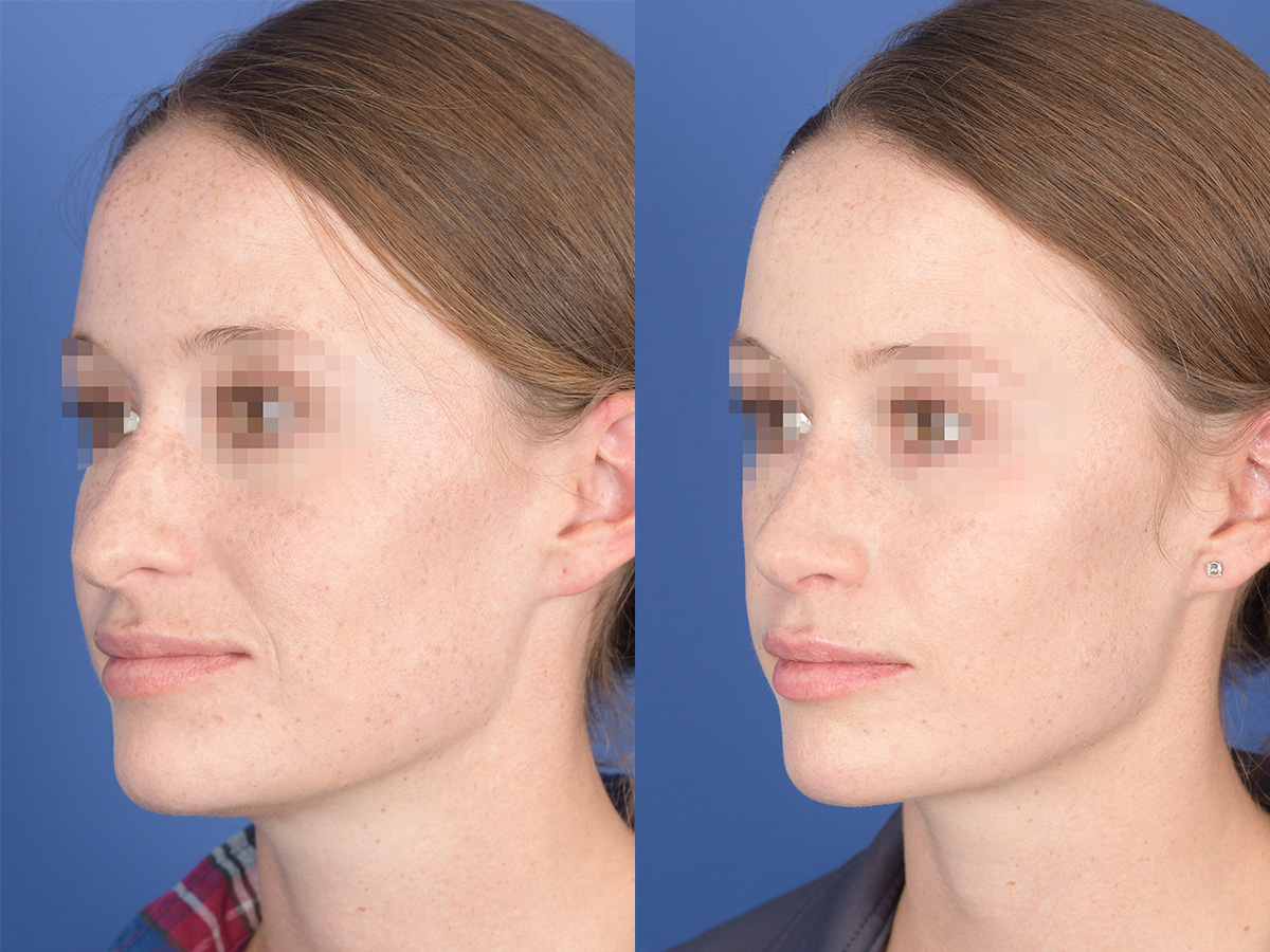 Rhinoplasty Before and After | Weber Facial Plastic Surgery