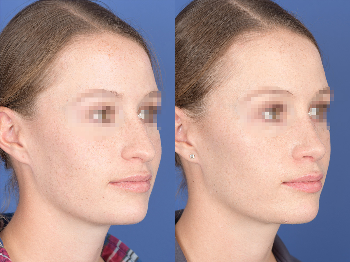 Rhinoplasty Before and After | Weber Facial Plastic Surgery
