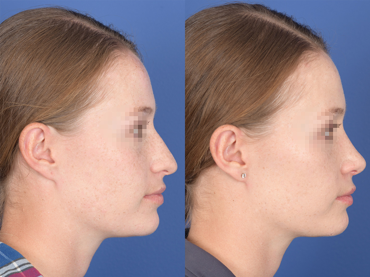 Rhinoplasty Before and After | Weber Facial Plastic Surgery