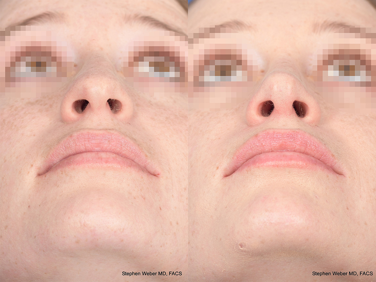 Rhinoplasty Before and After | Weber Facial Plastic Surgery
