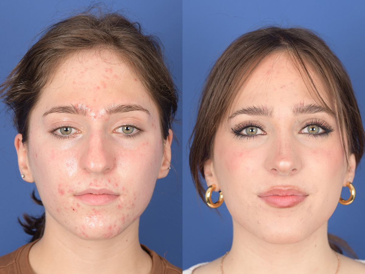Rhinoplasty Before and After | Weber Facial Plastic Surgery