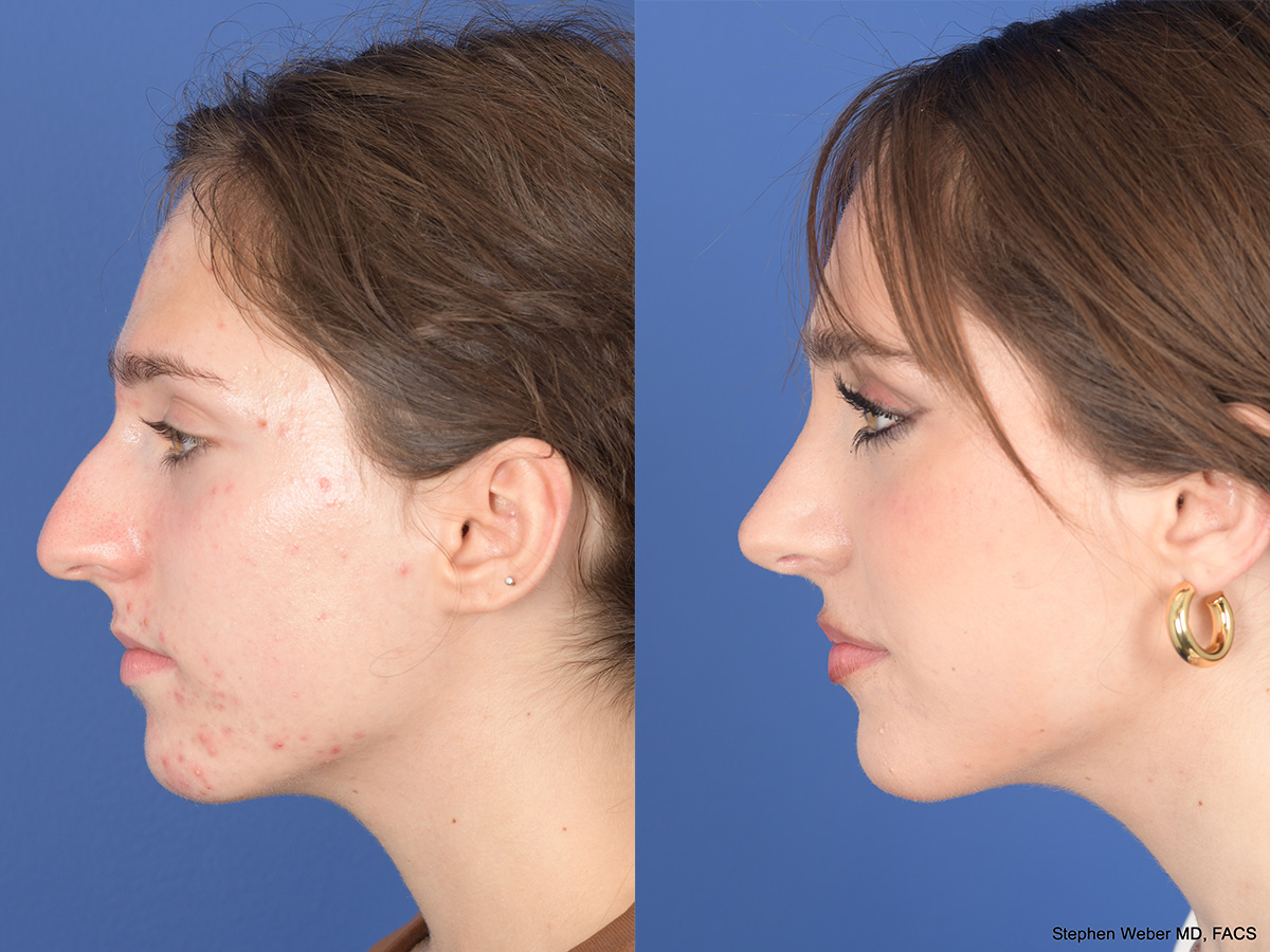 Rhinoplasty Before and After | Weber Facial Plastic Surgery
