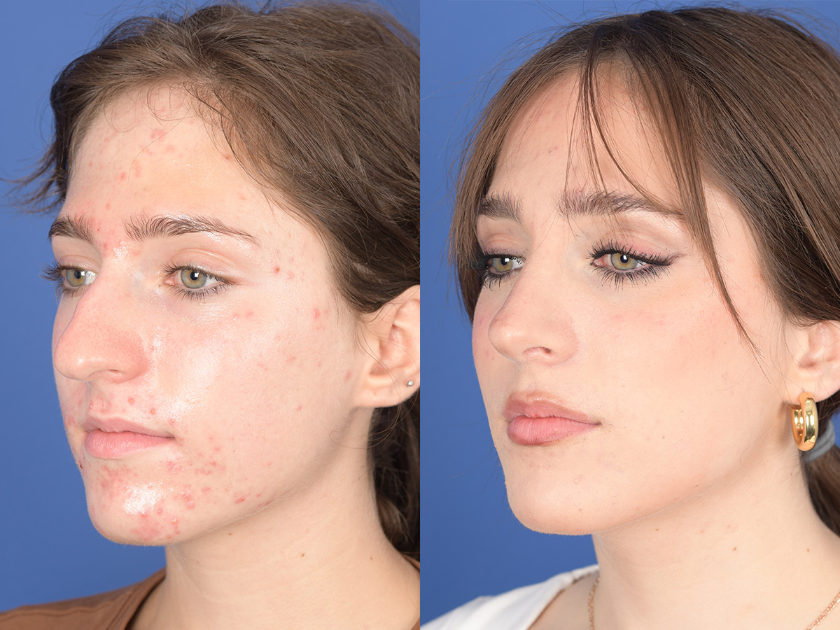 Rhinoplasty Before and After | Weber Facial Plastic Surgery