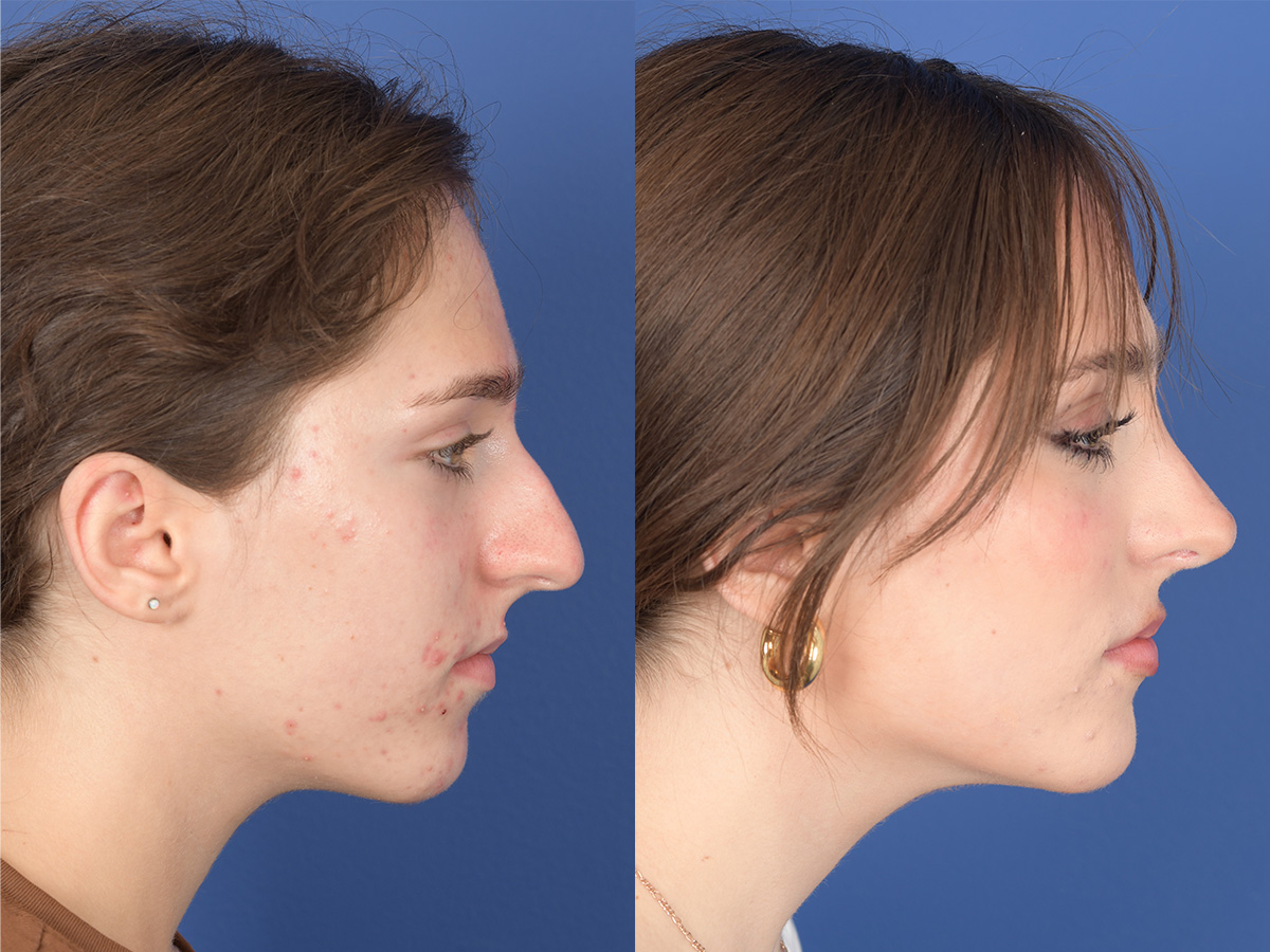 Rhinoplasty Before and After | Weber Facial Plastic Surgery