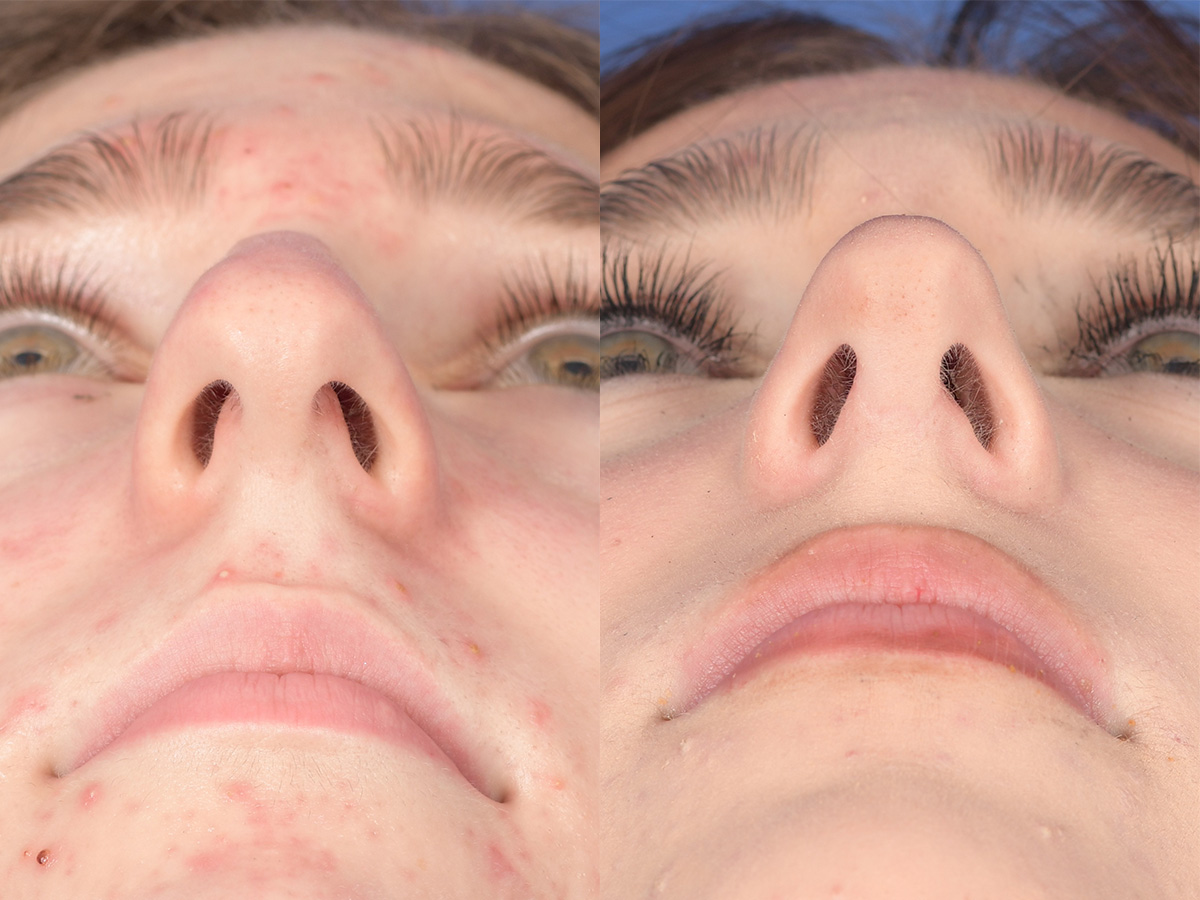 Rhinoplasty Before and After | Weber Facial Plastic Surgery
