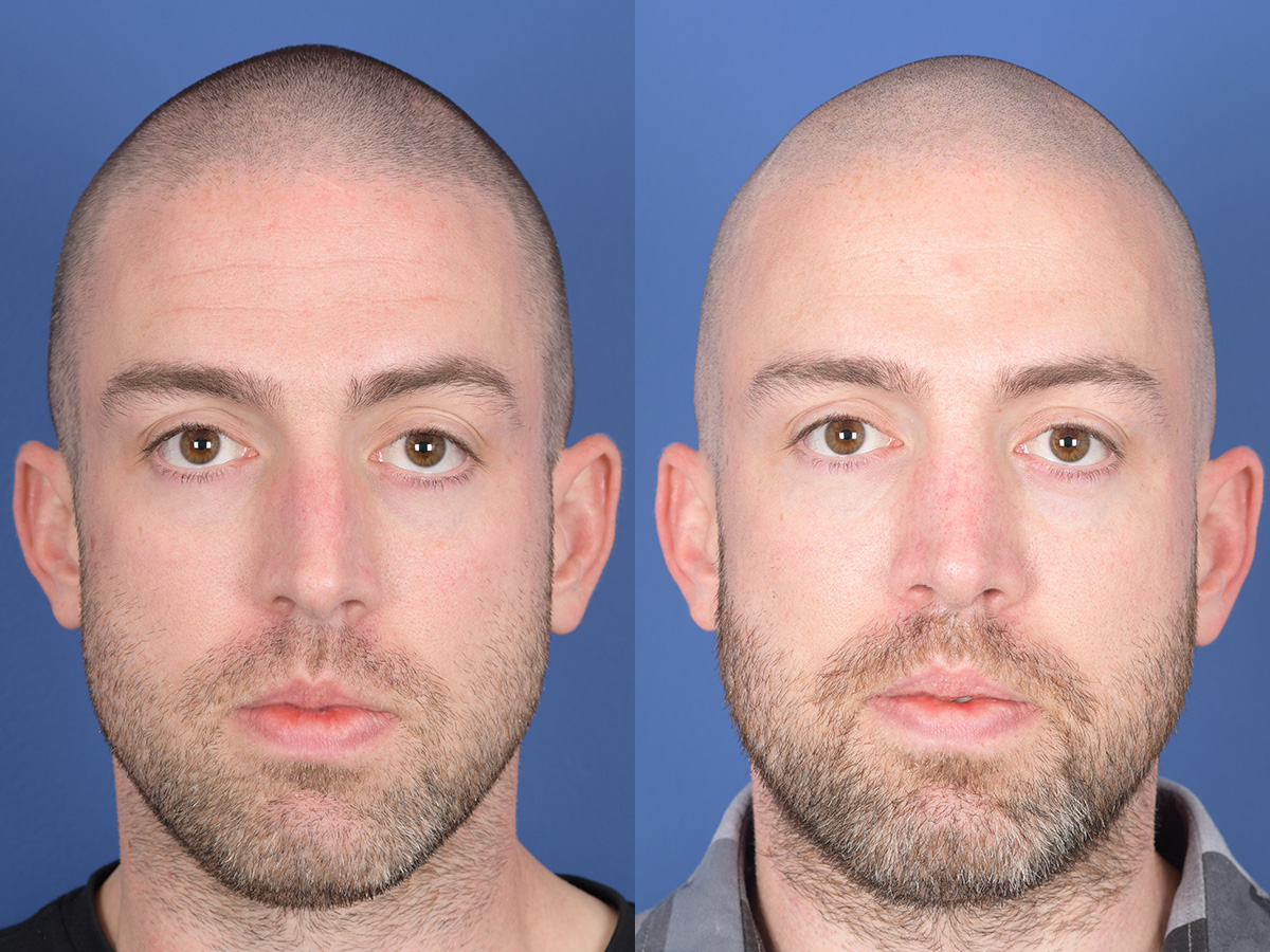Rhinoplasty Before and After | Weber Facial Plastic Surgery