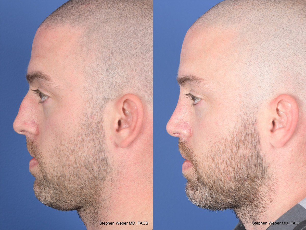 Rhinoplasty Before and After | Weber Facial Plastic Surgery
