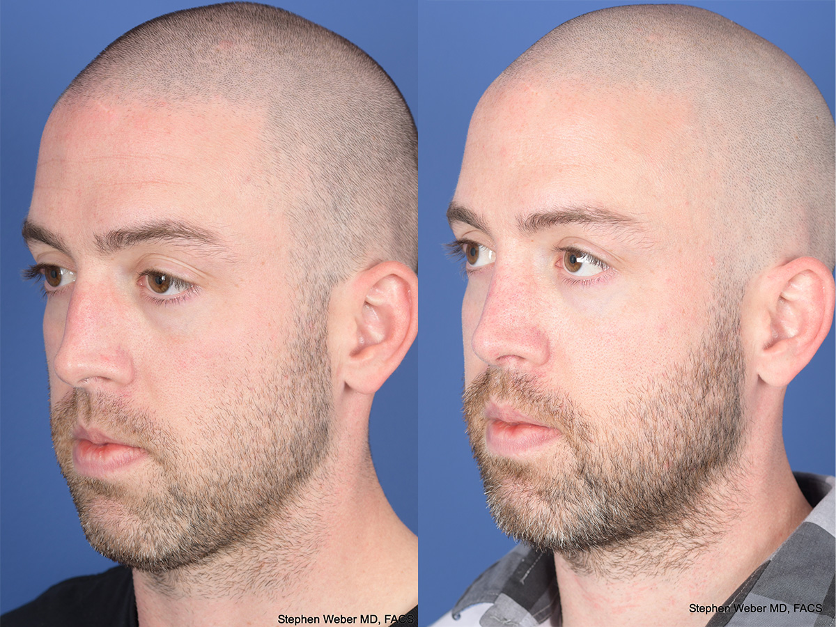 Rhinoplasty Before and After | Weber Facial Plastic Surgery