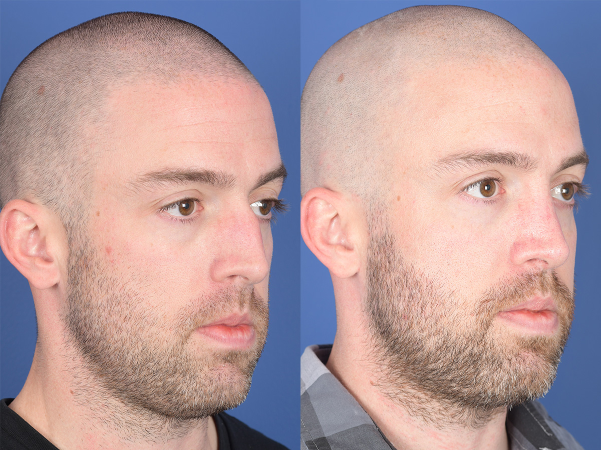 Rhinoplasty Before and After | Weber Facial Plastic Surgery