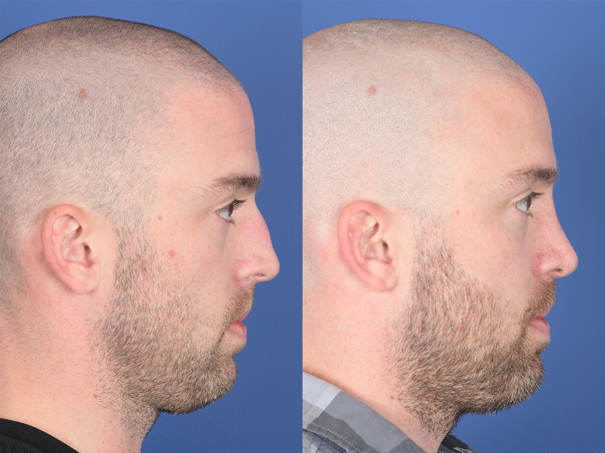 Rhinoplasty Before and After | Weber Facial Plastic Surgery