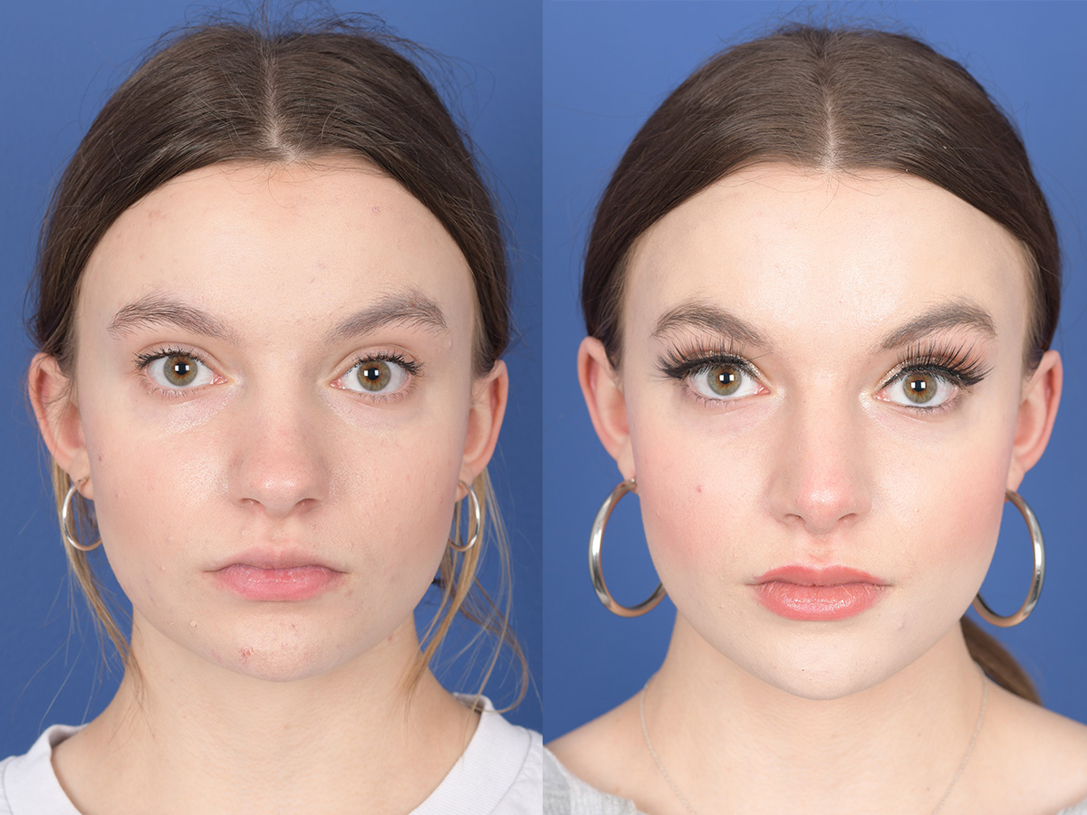 Rhinoplasty Before and After | Weber Facial Plastic Surgery
