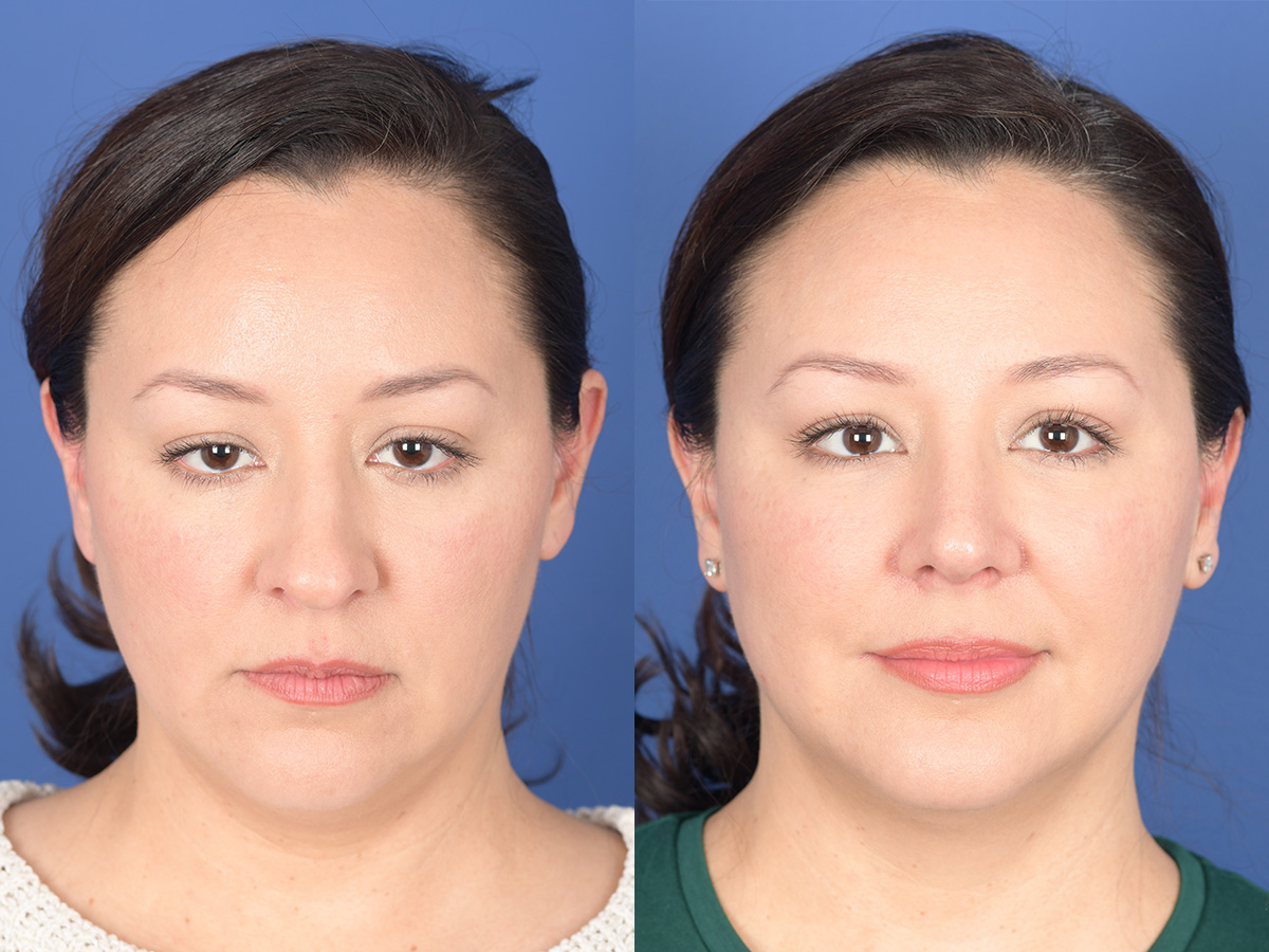 Rhinoplasty Before and After | Weber Facial Plastic Surgery