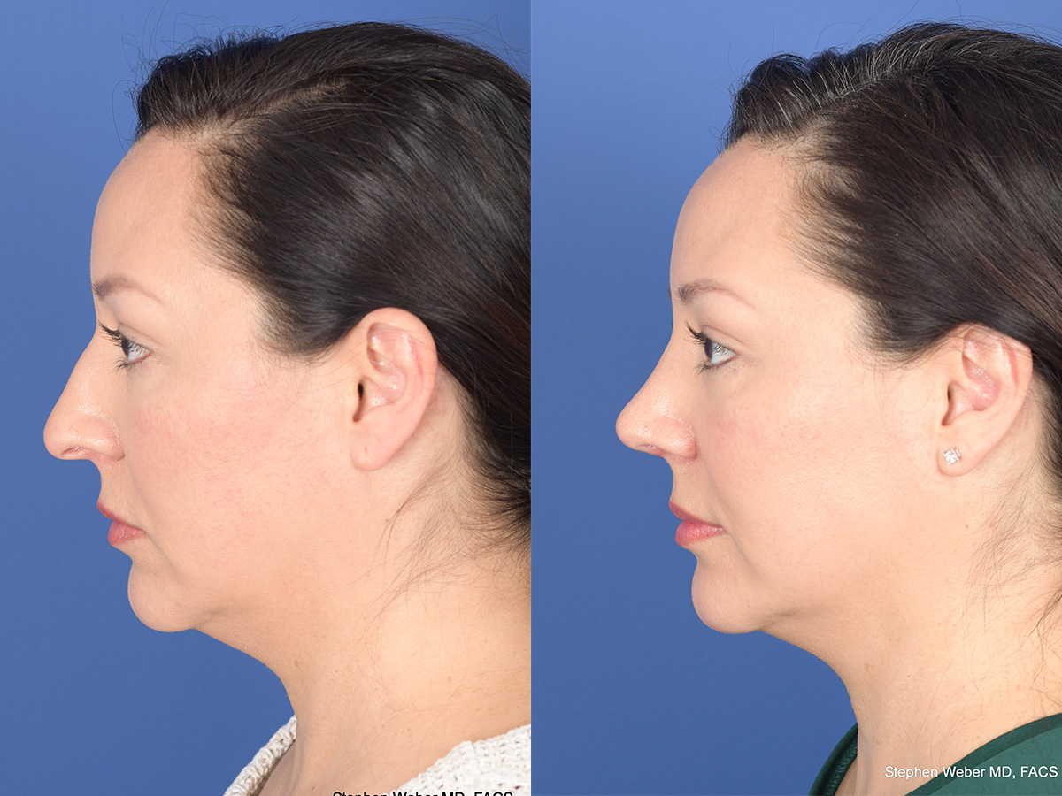 Rhinoplasty Before and After | Weber Facial Plastic Surgery