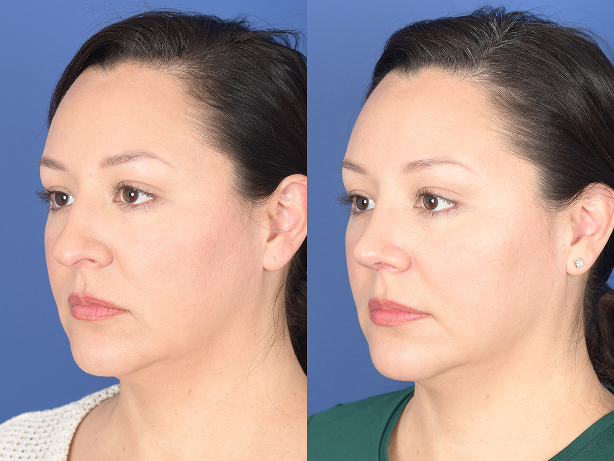 Rhinoplasty Before and After | Weber Facial Plastic Surgery