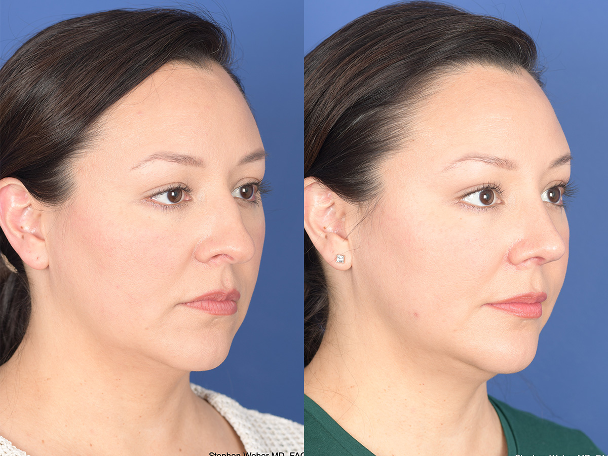 Rhinoplasty Before and After | Weber Facial Plastic Surgery