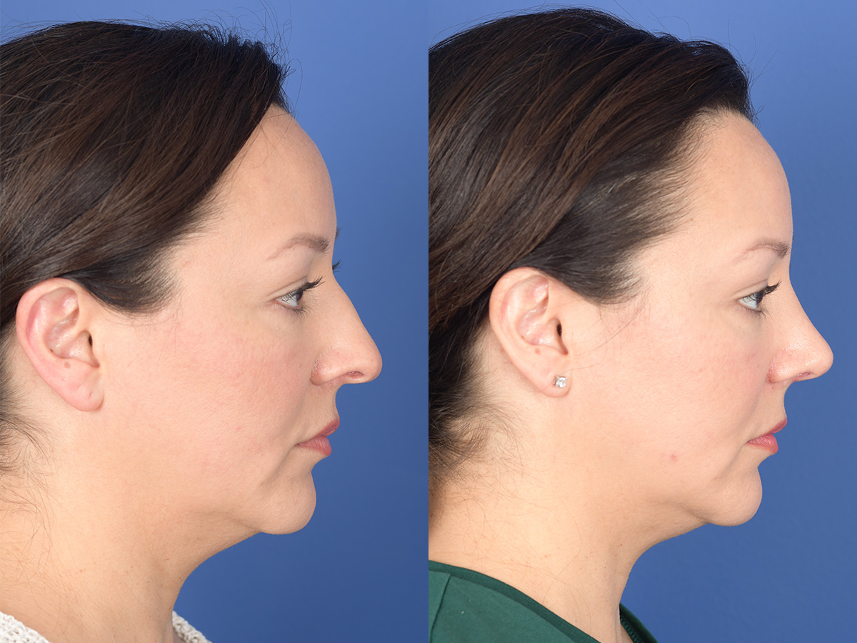 Rhinoplasty Before and After | Weber Facial Plastic Surgery