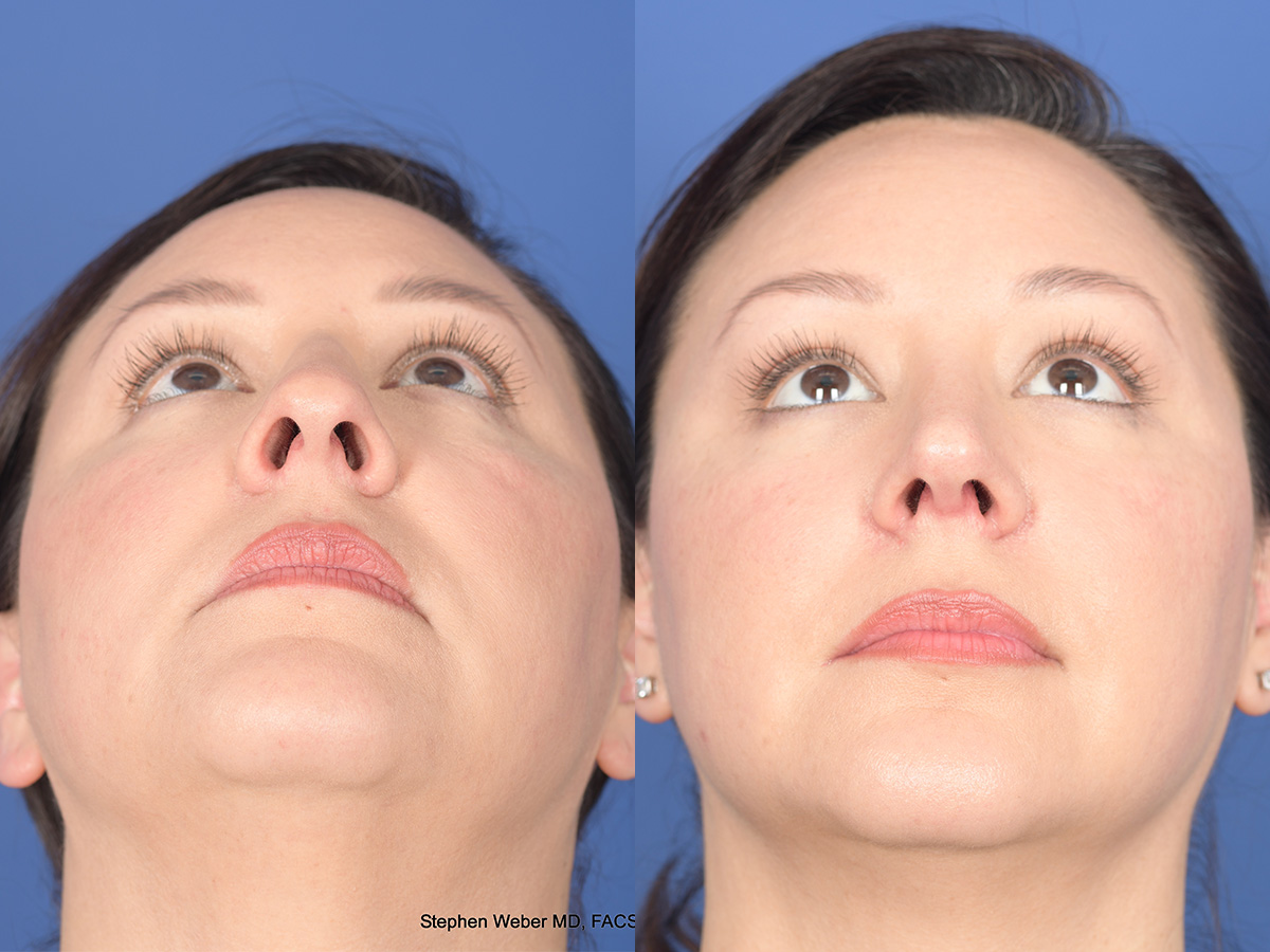 Rhinoplasty Before and After | Weber Facial Plastic Surgery