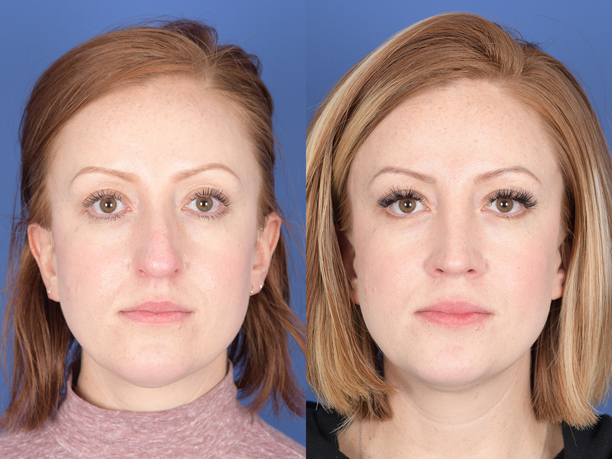 Rhinoplasty Before and After | Weber Facial Plastic Surgery