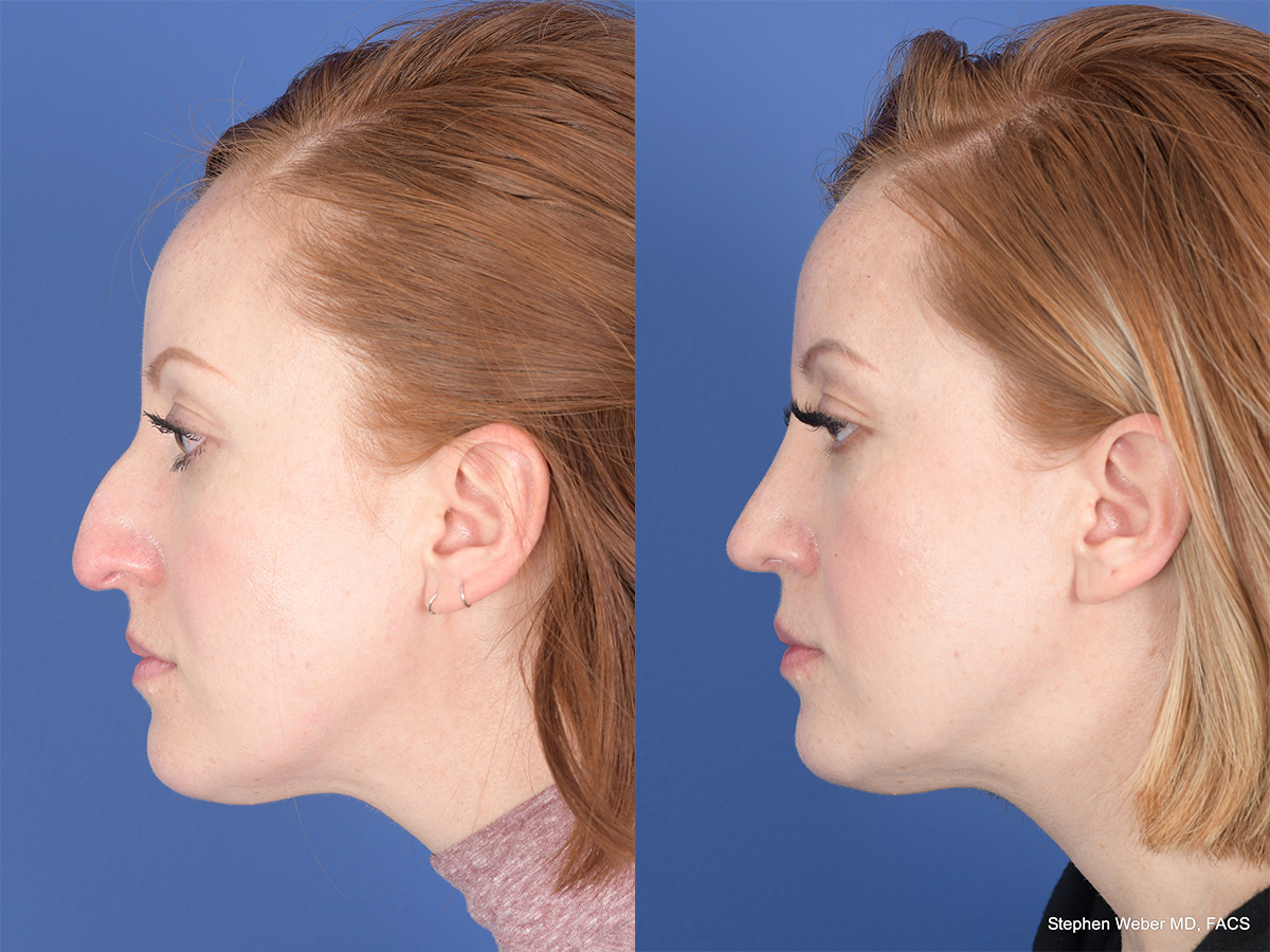 Rhinoplasty Before and After | Weber Facial Plastic Surgery