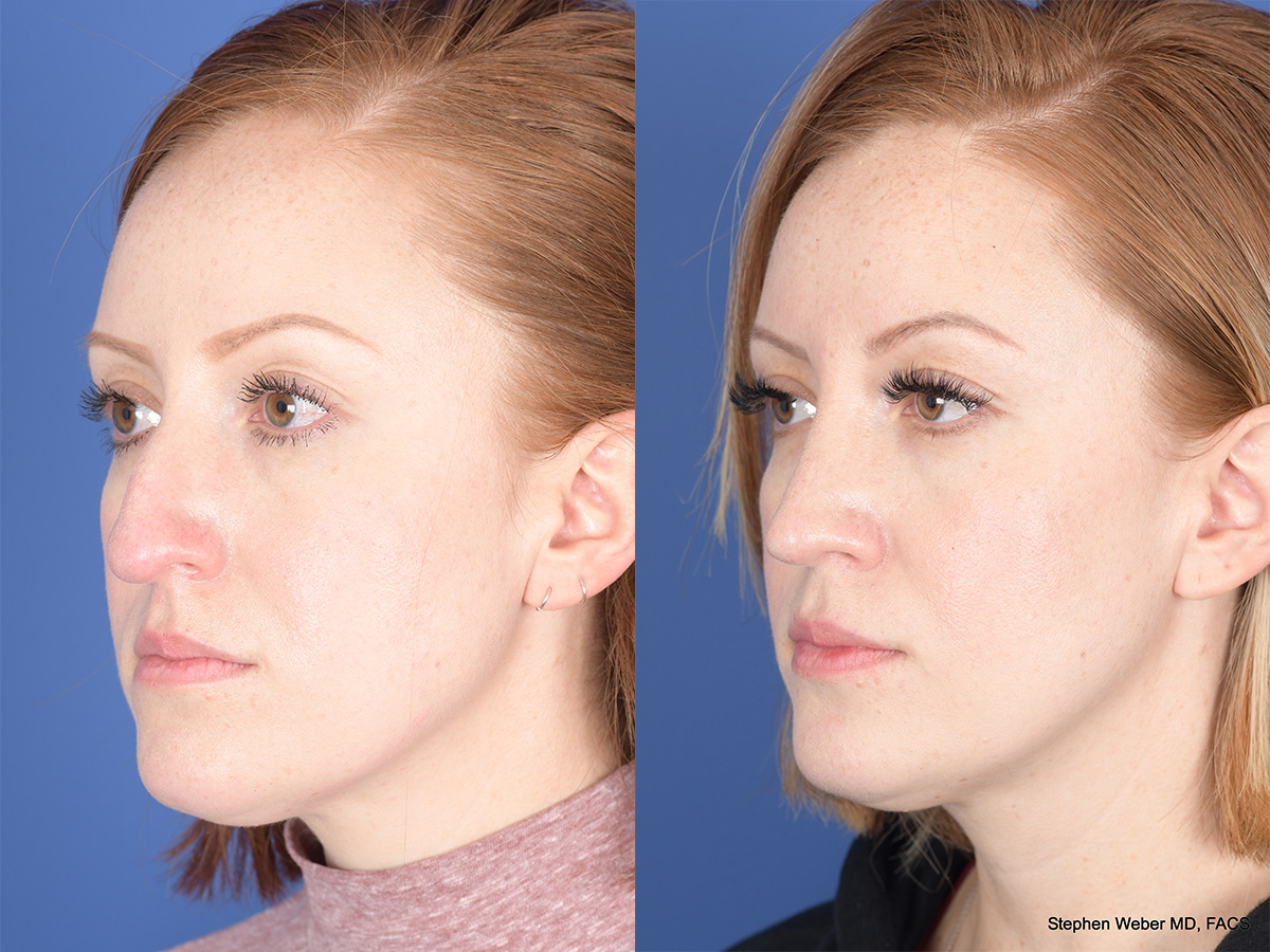 Rhinoplasty Before and After | Weber Facial Plastic Surgery
