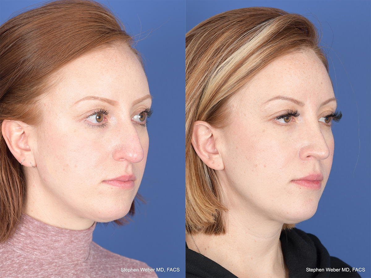 Rhinoplasty Before and After | Weber Facial Plastic Surgery