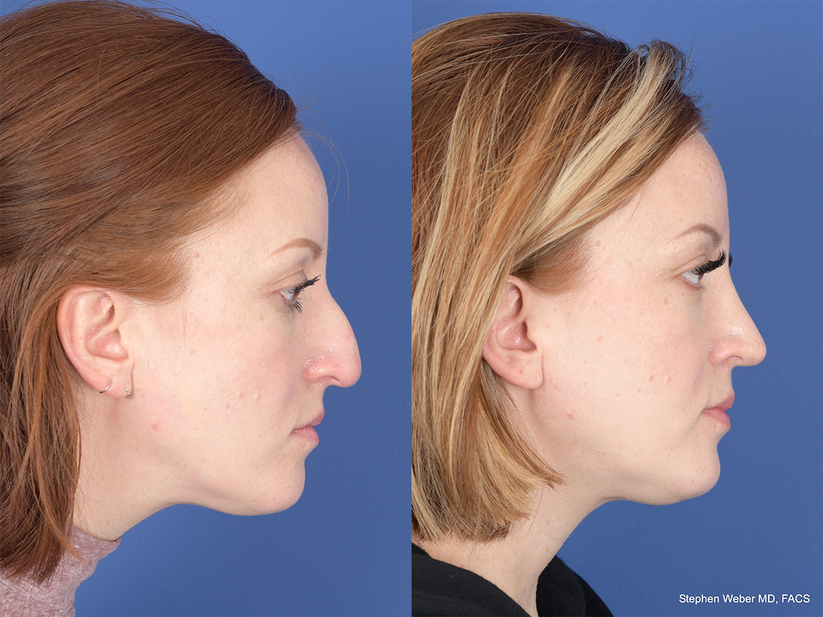 Rhinoplasty Before and After | Weber Facial Plastic Surgery