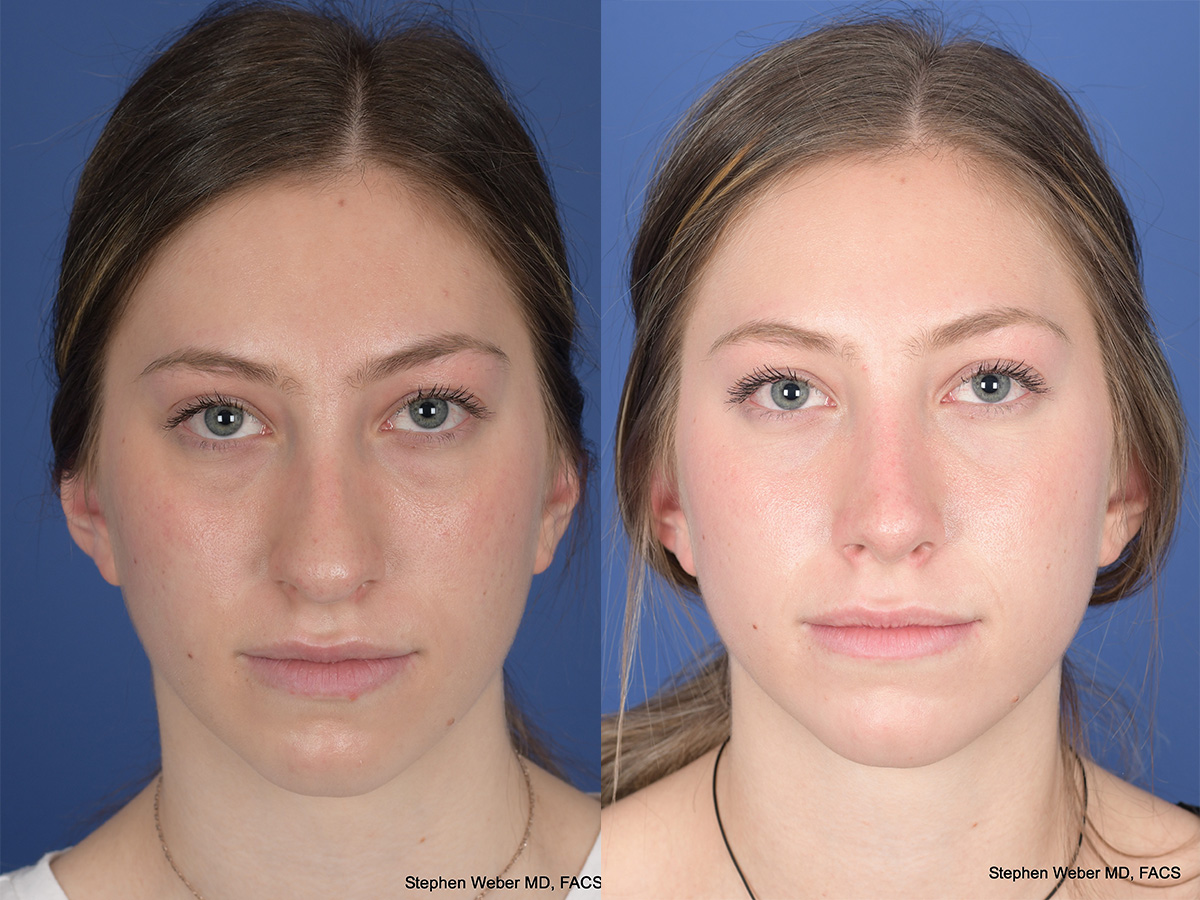 Rhinoplasty Before and After | Weber Facial Plastic Surgery