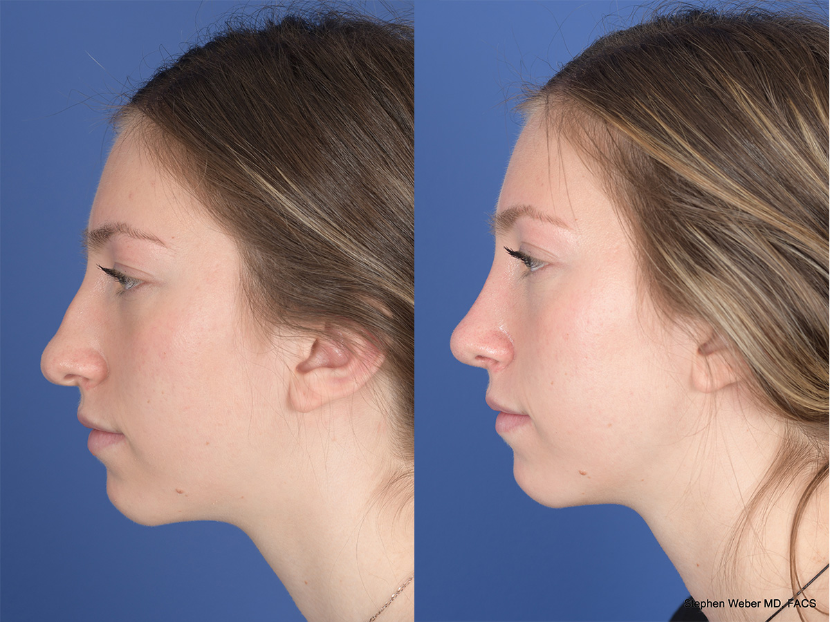Rhinoplasty Before and After | Weber Facial Plastic Surgery