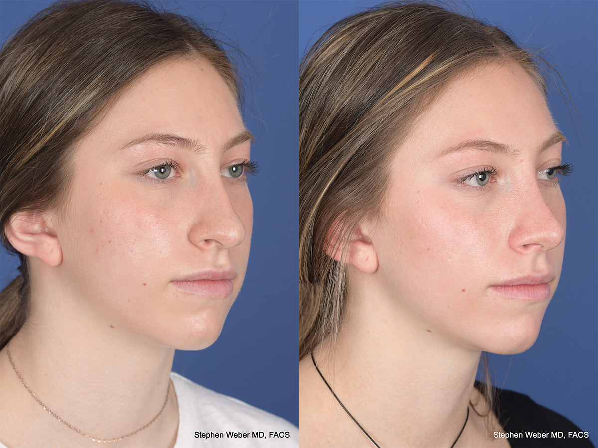 Rhinoplasty Before and After | Weber Facial Plastic Surgery