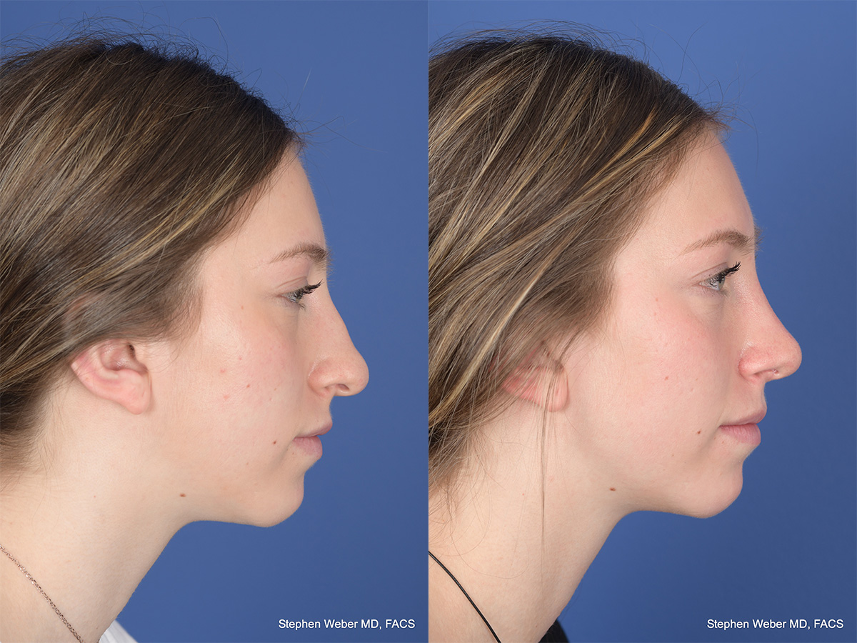 Rhinoplasty Before and After | Weber Facial Plastic Surgery