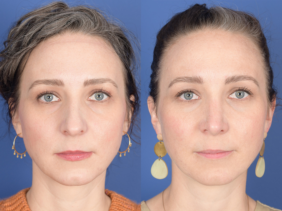 Rhinoplasty Before and After | Weber Facial Plastic Surgery