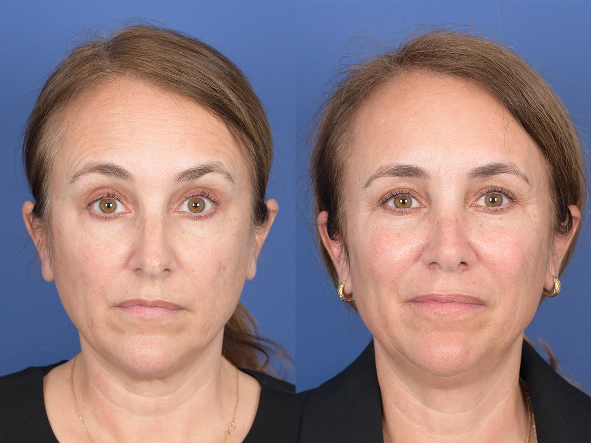 Rhinoplasty Before and After | Weber Facial Plastic Surgery