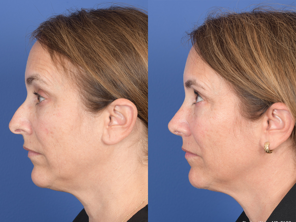 Rhinoplasty Before and After | Weber Facial Plastic Surgery