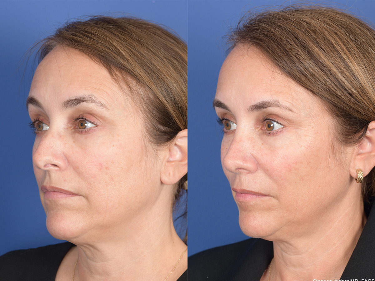 Rhinoplasty Before and After | Weber Facial Plastic Surgery