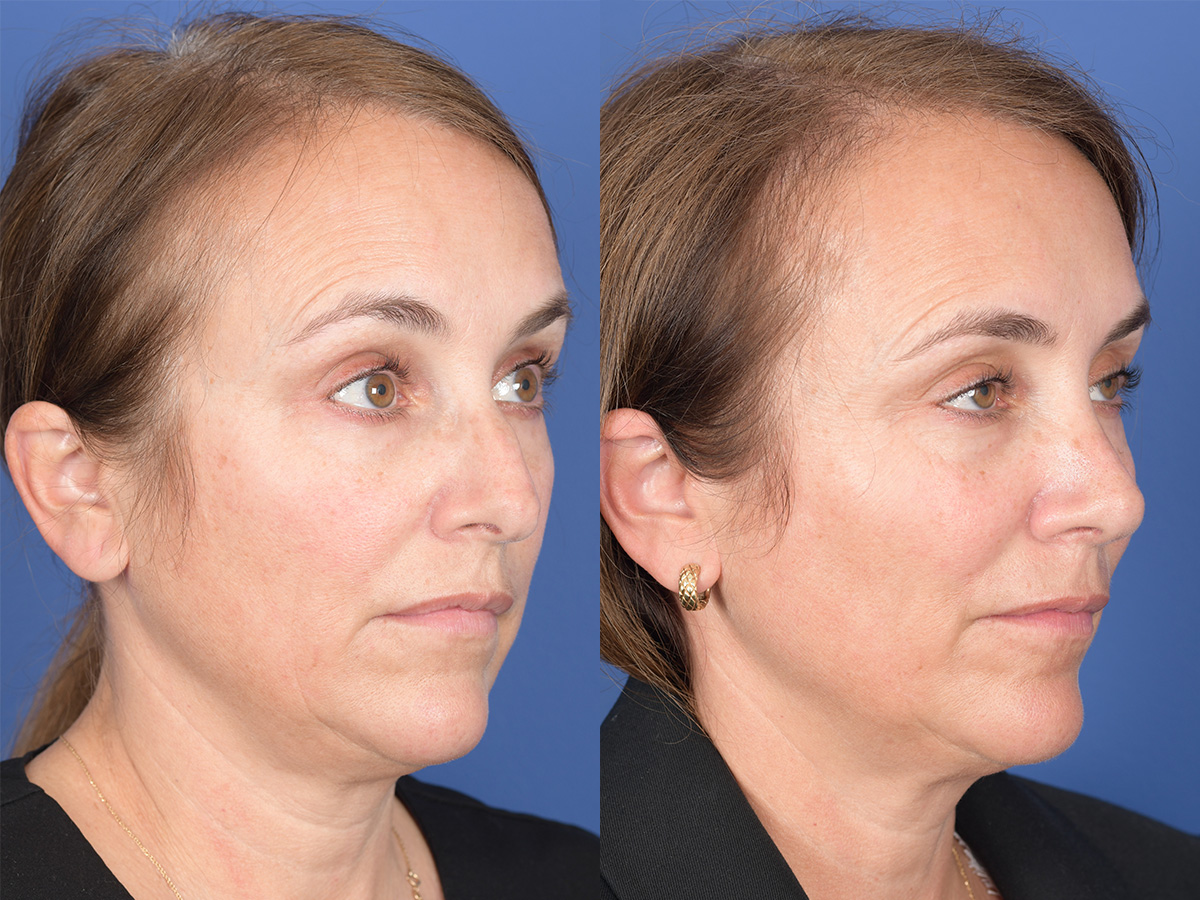 Rhinoplasty Before and After | Weber Facial Plastic Surgery