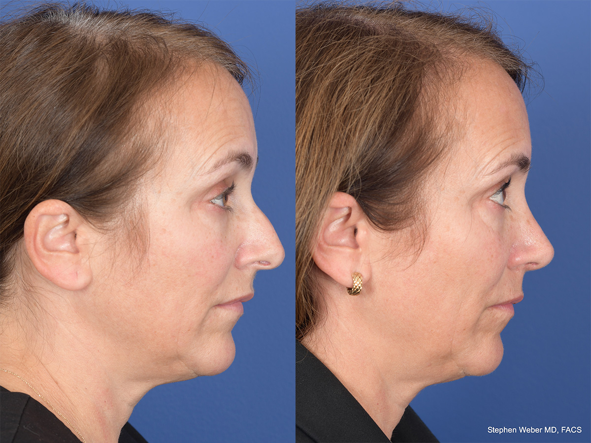 Rhinoplasty Before and After | Weber Facial Plastic Surgery