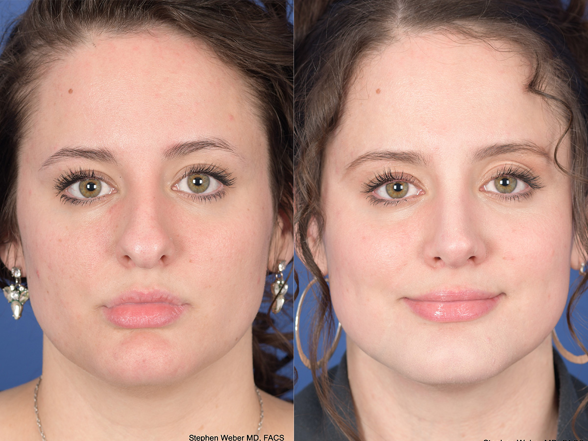 Rhinoplasty Before and After | Weber Facial Plastic Surgery