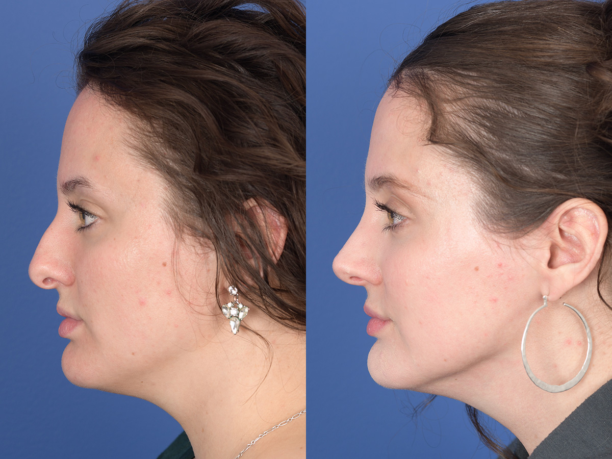 Rhinoplasty Before and After | Weber Facial Plastic Surgery