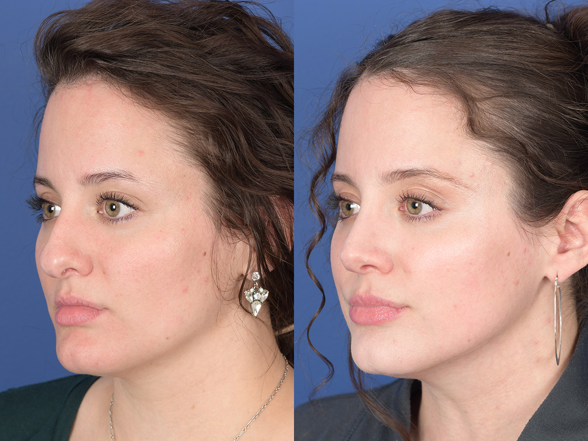 Rhinoplasty Before and After | Weber Facial Plastic Surgery