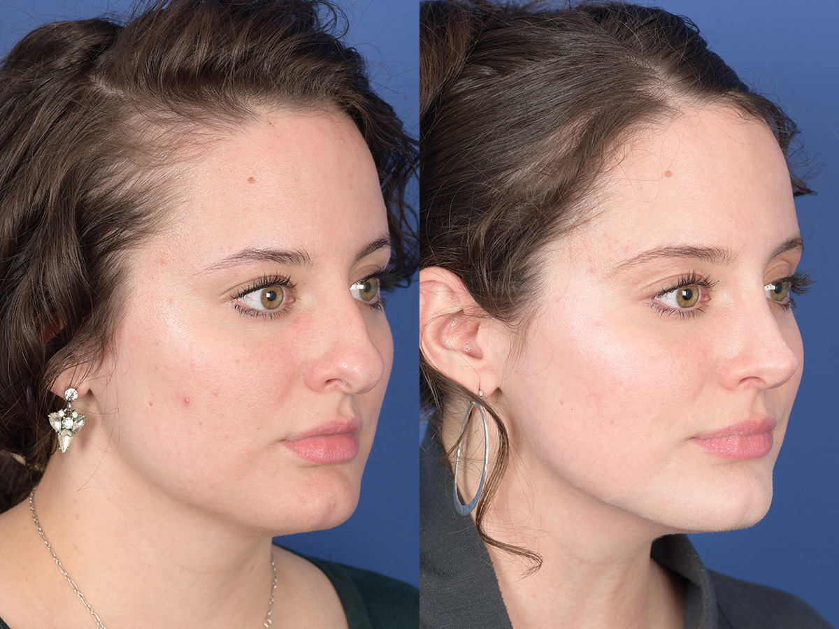 Rhinoplasty Before and After | Weber Facial Plastic Surgery