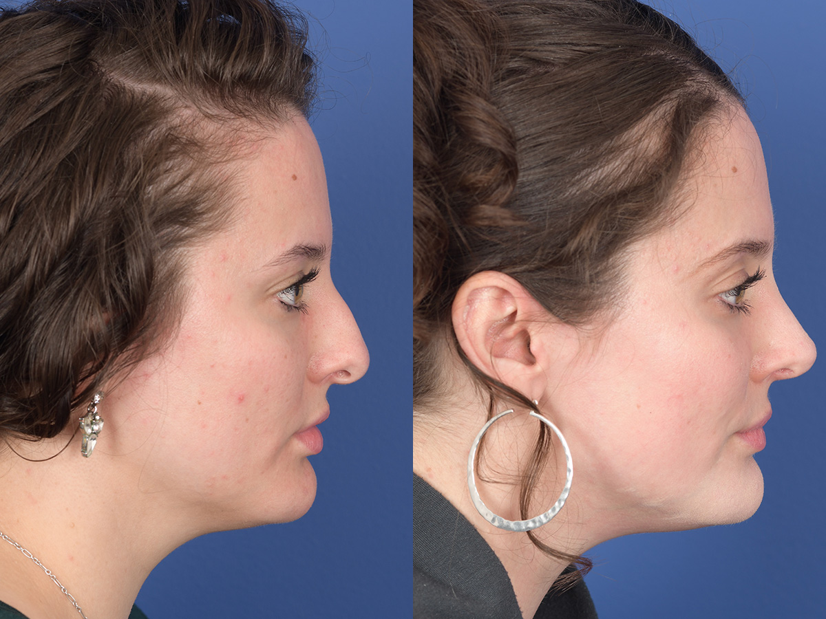 Rhinoplasty Before and After | Weber Facial Plastic Surgery